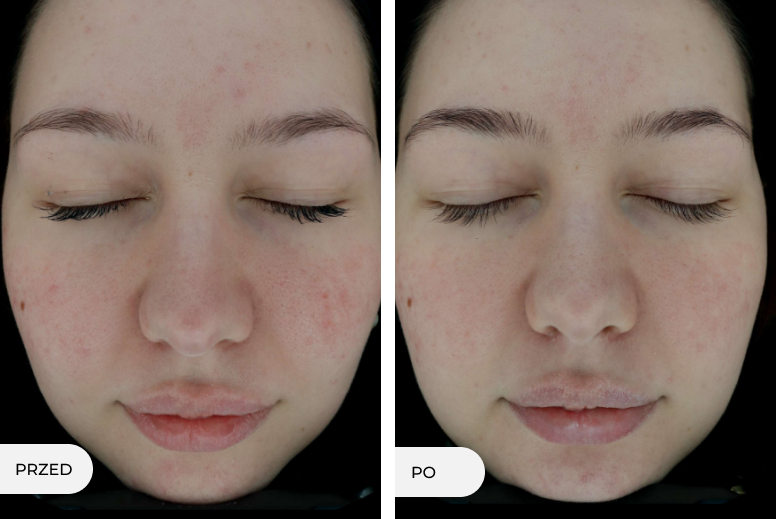 Grafika przedstawiająca po lewej stronie stan skóry przed, po prawej po miesiącu indywidualnie dobranej pielęgnacji kosmetycznej.