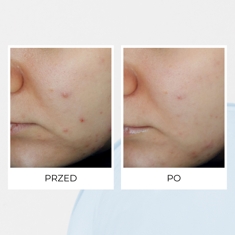 Efekty stosowania serii MIKROBIOM - przed i po