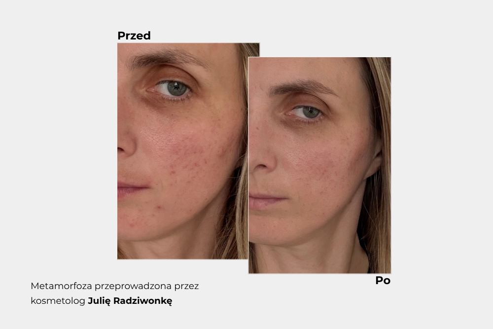 Skóra wrażliwa i reaktywna – jak odbudować barierę hydrolipidową? Metamorfoza Eweliny