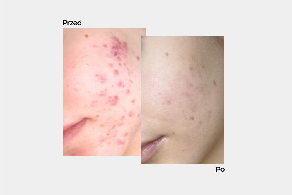 Jak pokonać suchość i nadwrażliwość? Rola pielęgnacji w odbudowie bariery naskórkowej podczas leczenia dermatologicznego