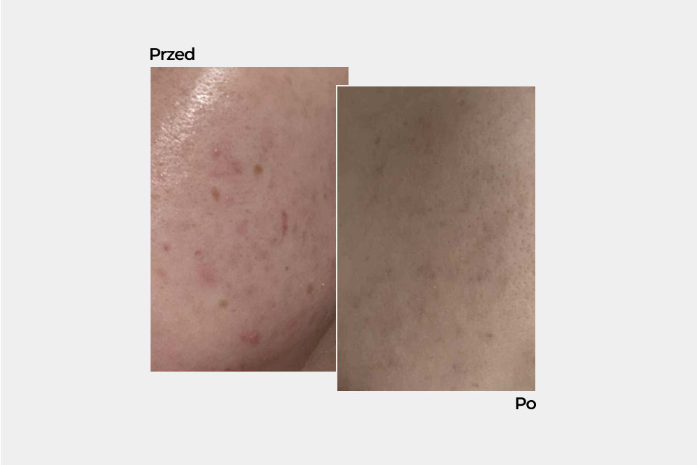 Jak wyciszyć zaburzoną i reaktywną cerę? Zobacz metamorfozę Patrycji 