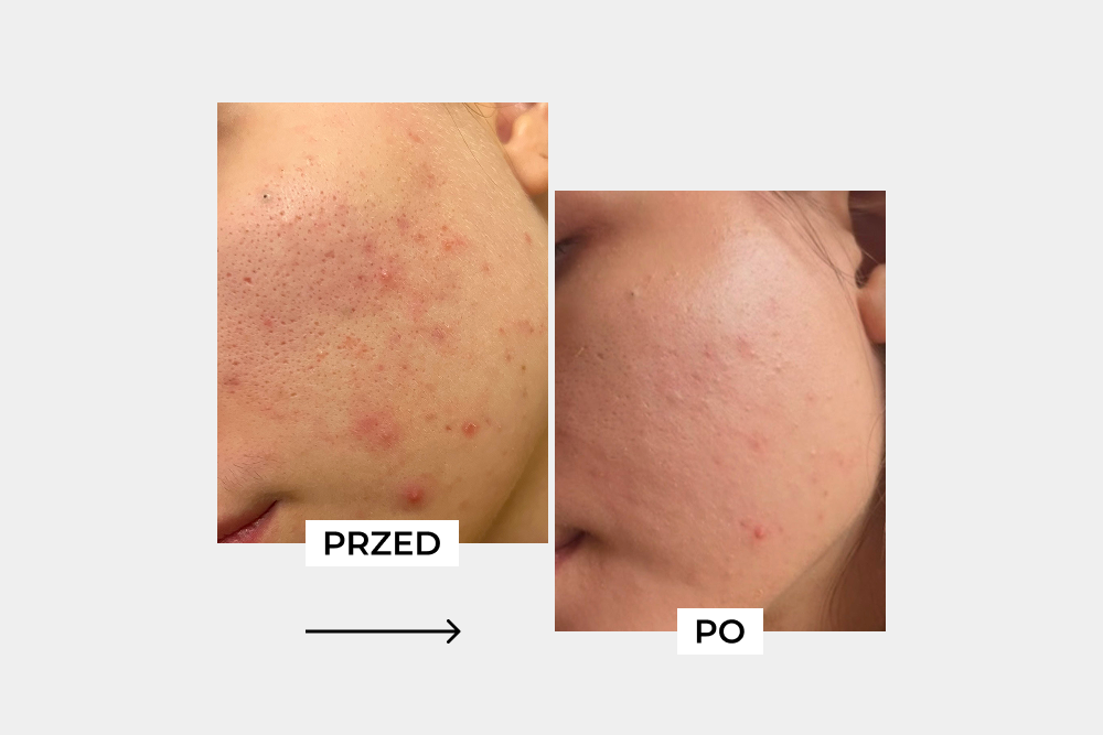 Zaburzona bariera hydrolipidowa i podrażniona skóra Pani Uli – co było jej przyczyną i jak przywróciłyśmy równowagę