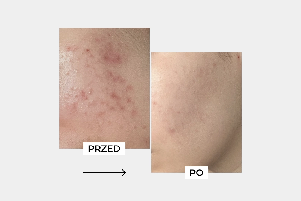 Jak Natalia pokonała trądzik w 12 tygodni: metamorfoza skóry, która odzyskała równowagę