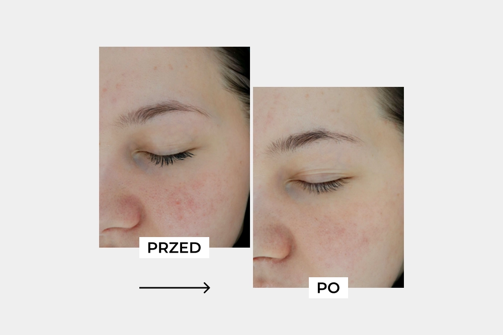 Zaczerwieniona i sucha skóra? To problem wielu kobiet. Metamorfoza Julii