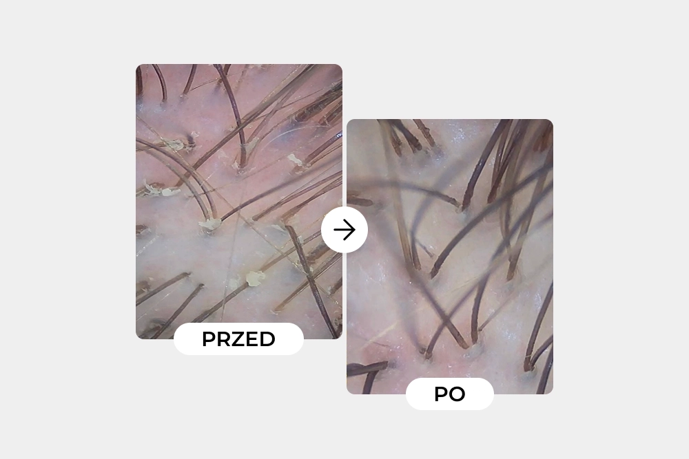 Metamorfoza przetłuszczającej się skóry głowy – jak Kasia odzyskała równowagę i świeżość włosów