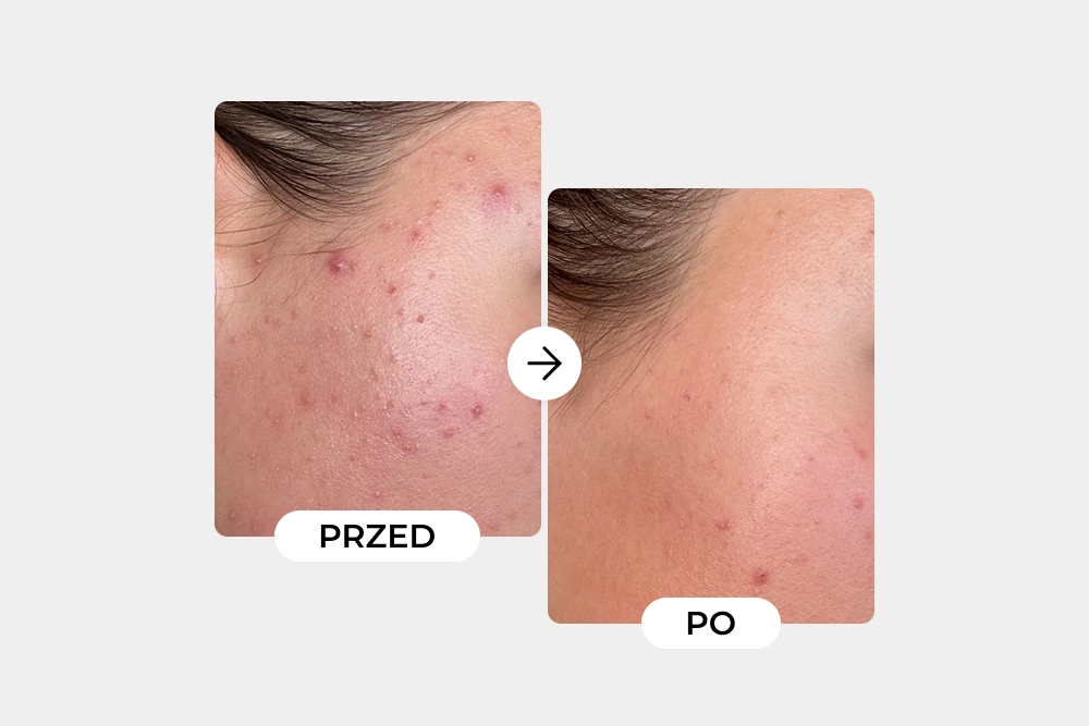 Metamorfoza skóry Luizy – jak uporządkowanie pielęgnacji i wsparcie mikrobiomu wyciszyły niedoskonałości